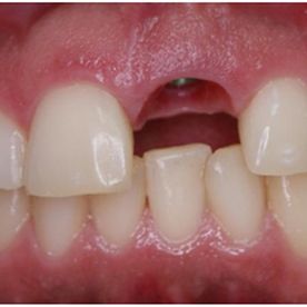 Espai Dental implante dental estético 2