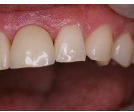 Espai Dental implante dental estético 1