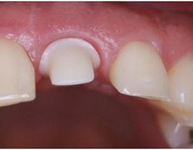 Espai Dental implante dental estético 3